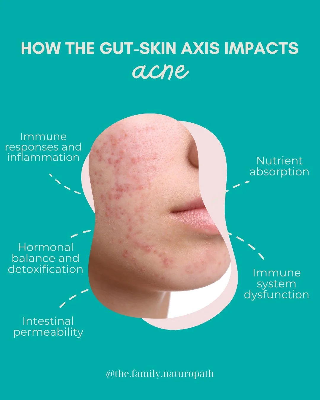 Your gut and skin are in constant conversation, and when the gut&rsquo;s out of balance, the skin often speaks up. 🧬✨

Here&rsquo;s how the gut-skin axis impacts your skin health:

🦠 Gut dysbiosis (an imbalanced microbiome) and leaky gut (increased
