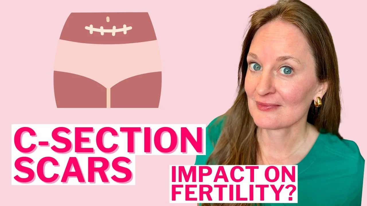 Uncovering the Hidden Impact of C-Sections: Understanding Isthmocele and Its Effect on Fertility