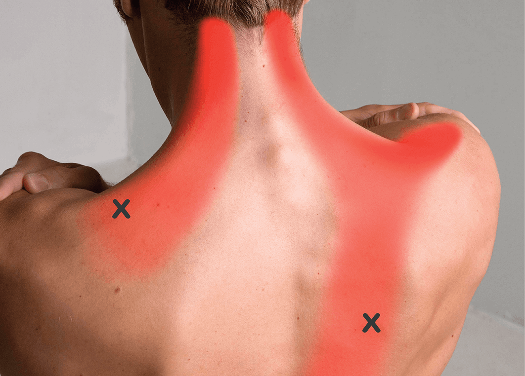 Trigger-Point-Trapezius-Pattern-1.png