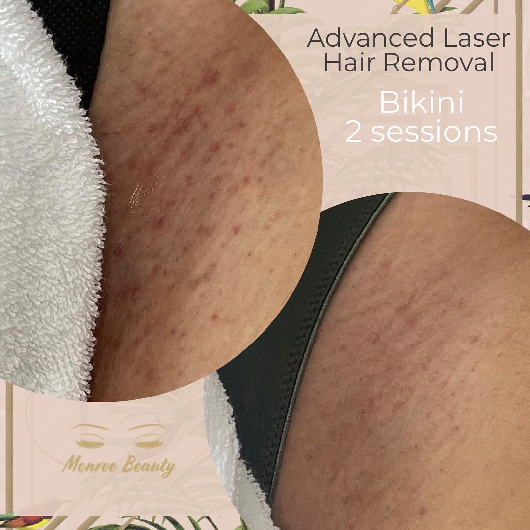 While shaving, epilation, waxing and depilatory creams are reasonable short-term solutions to hair removal, they can also cause sensitivity and in-growing hairs to those that use them.

Laser hair removal is a rapid, yet gentle way of removing unwant