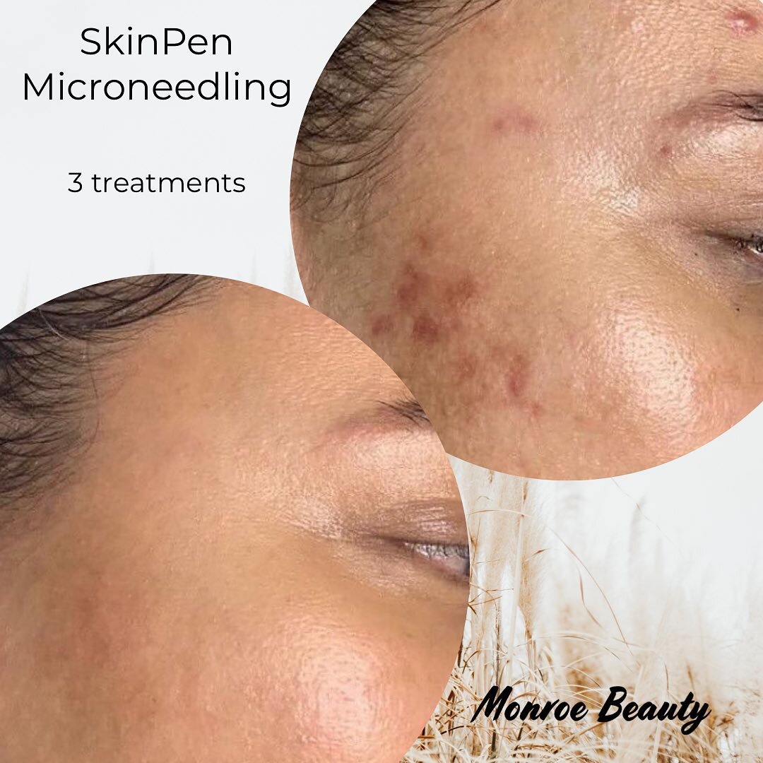 SkinPen Microneedling - 3 treatments 

SkinPen has several tiny needles at the tip of it that move up and down to create micro-tears on the surface of your skin.

This controlled injury to your skin triggers your body to produce collagen and elastin 