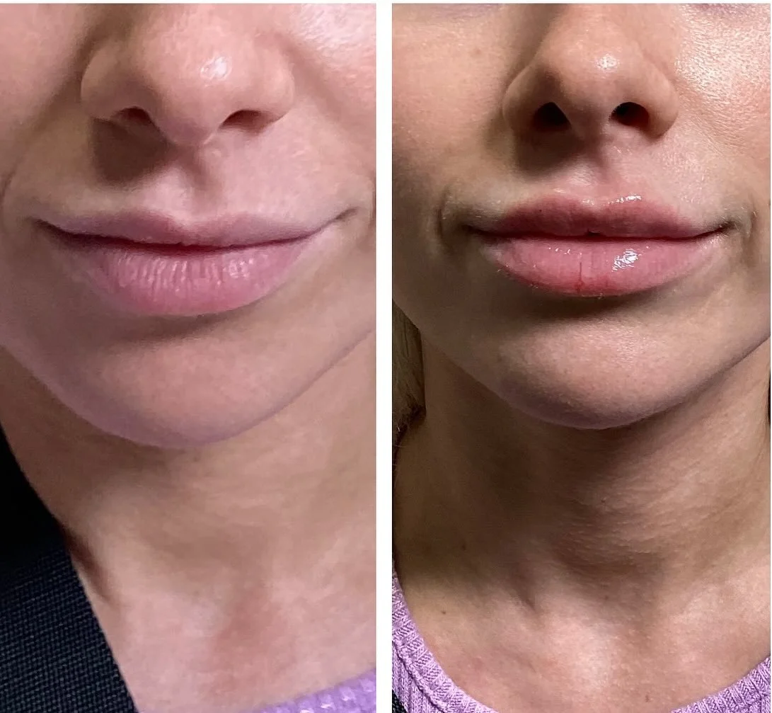 💋So obsessed with how these lips turned out. Did you know that our mini lip filler is now permanently on the schedule?! Schedule yours today! Soooo many of you said yes to mini lip filler and we love it! 

Injector: Anna Castellanos, APRN-CNP