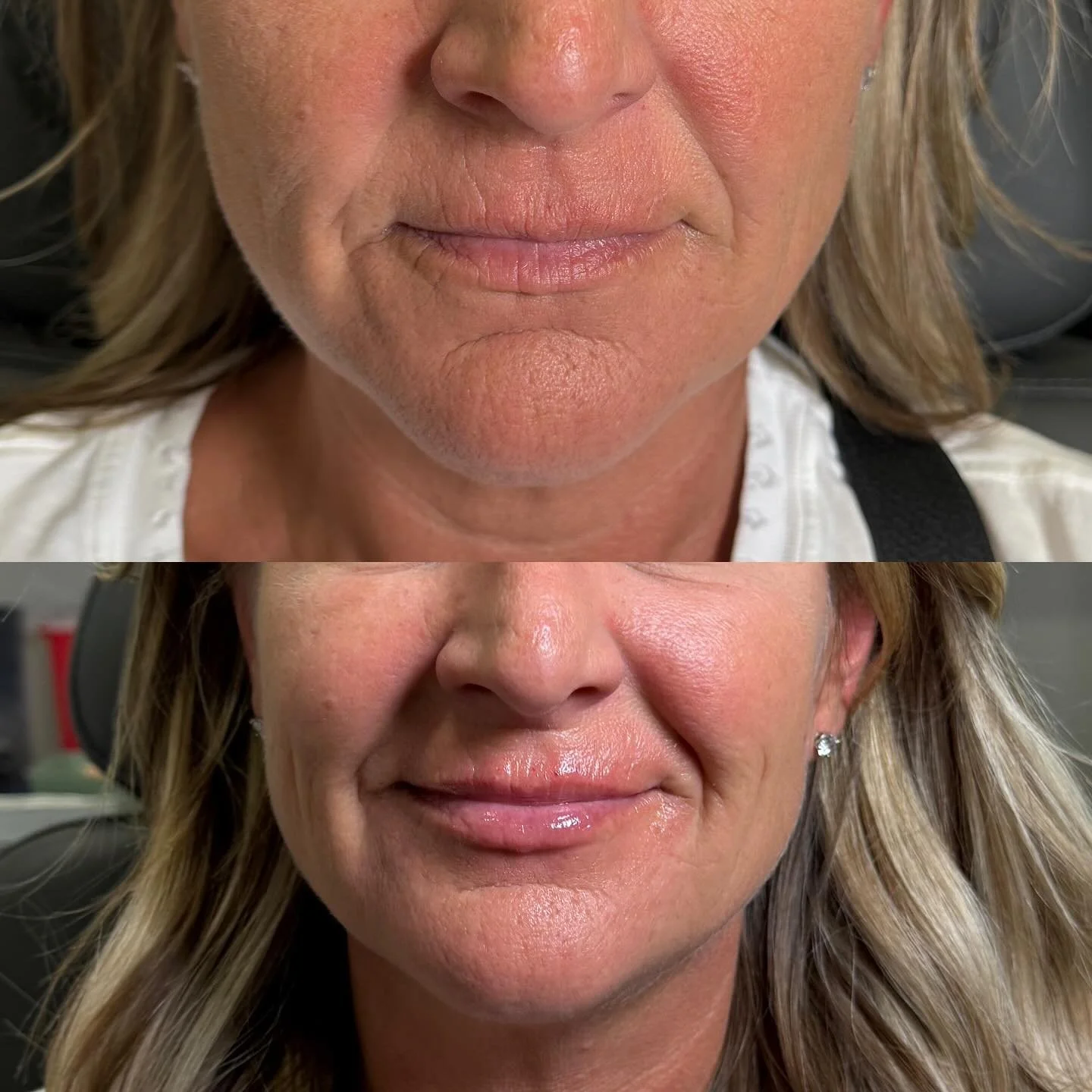 Mini Lip Filler 💉
This queen asked, and it was delivered 👑
Soft. Balanced. Timeless.

&ndash; Injector Ashley Williamson, CNP
#lipfillers #medspa