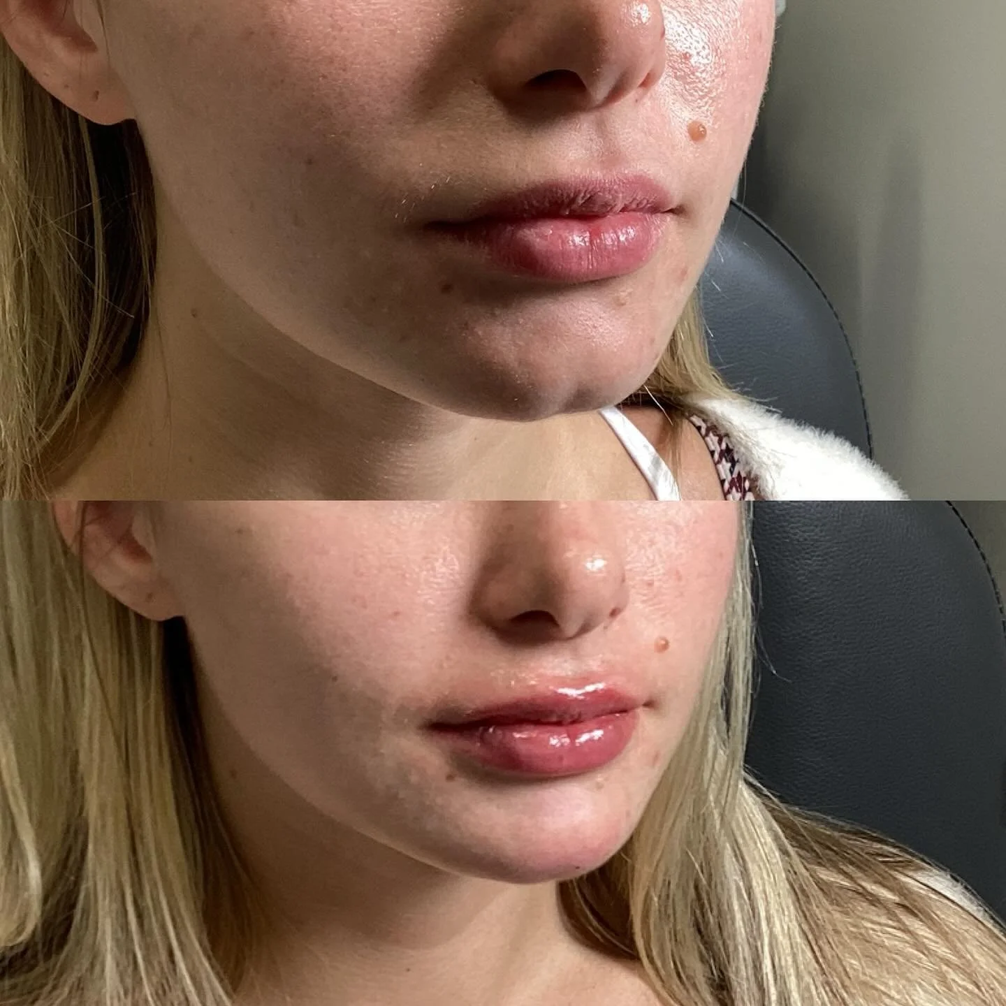 Happy Monday ✨
Perfect example of facial balancing with lips + chin 💉

This beautiful patient had a deep chin cleft that had always bothered her. We softened the area for a smoother, more rounded profile &mdash; and added a subtle plump to her lips 