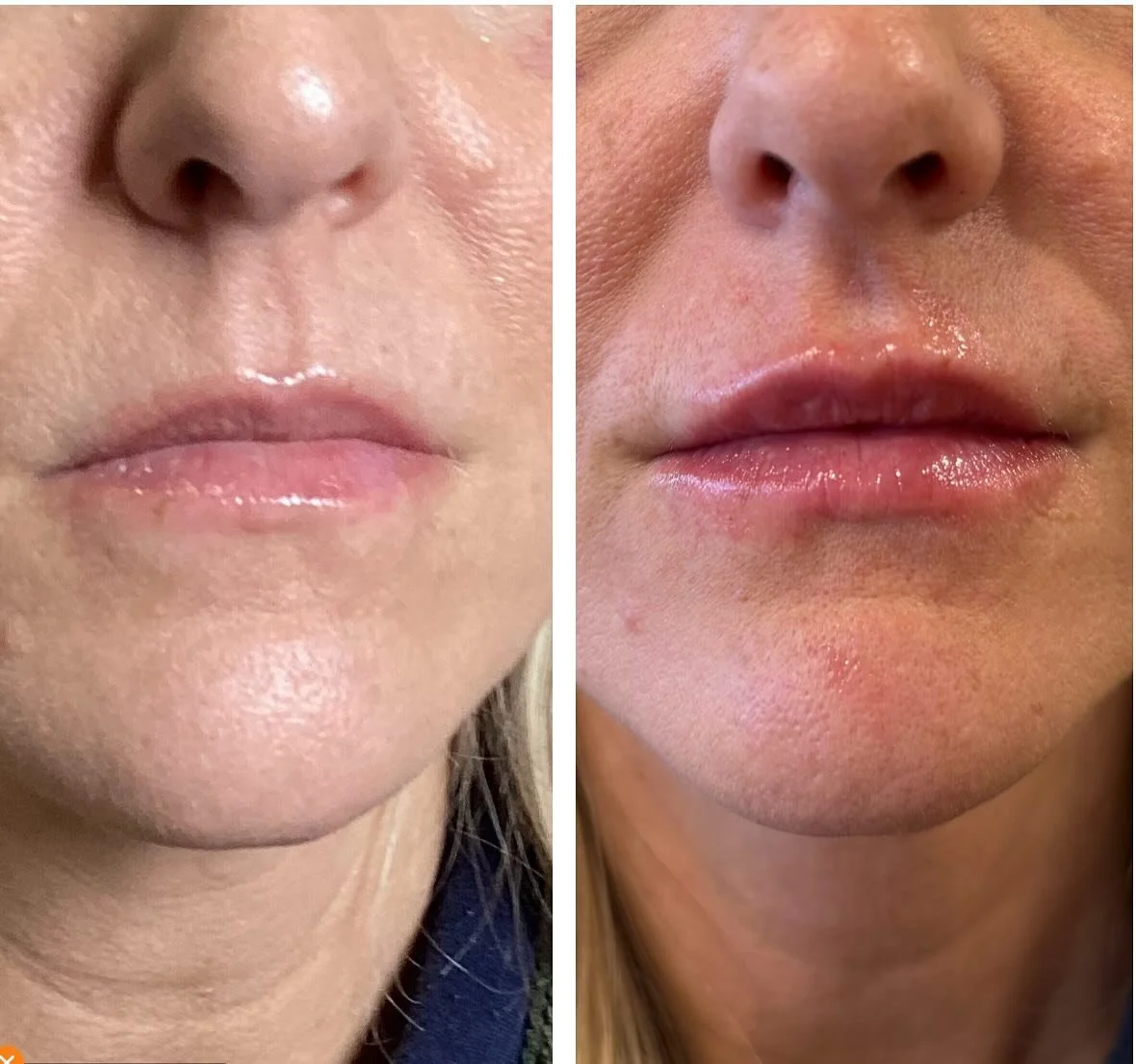 Just enough lip filler to make a difference 🫶🏼Sooo pretty. 
Injector-Anna Castellanos, APRN-CNP