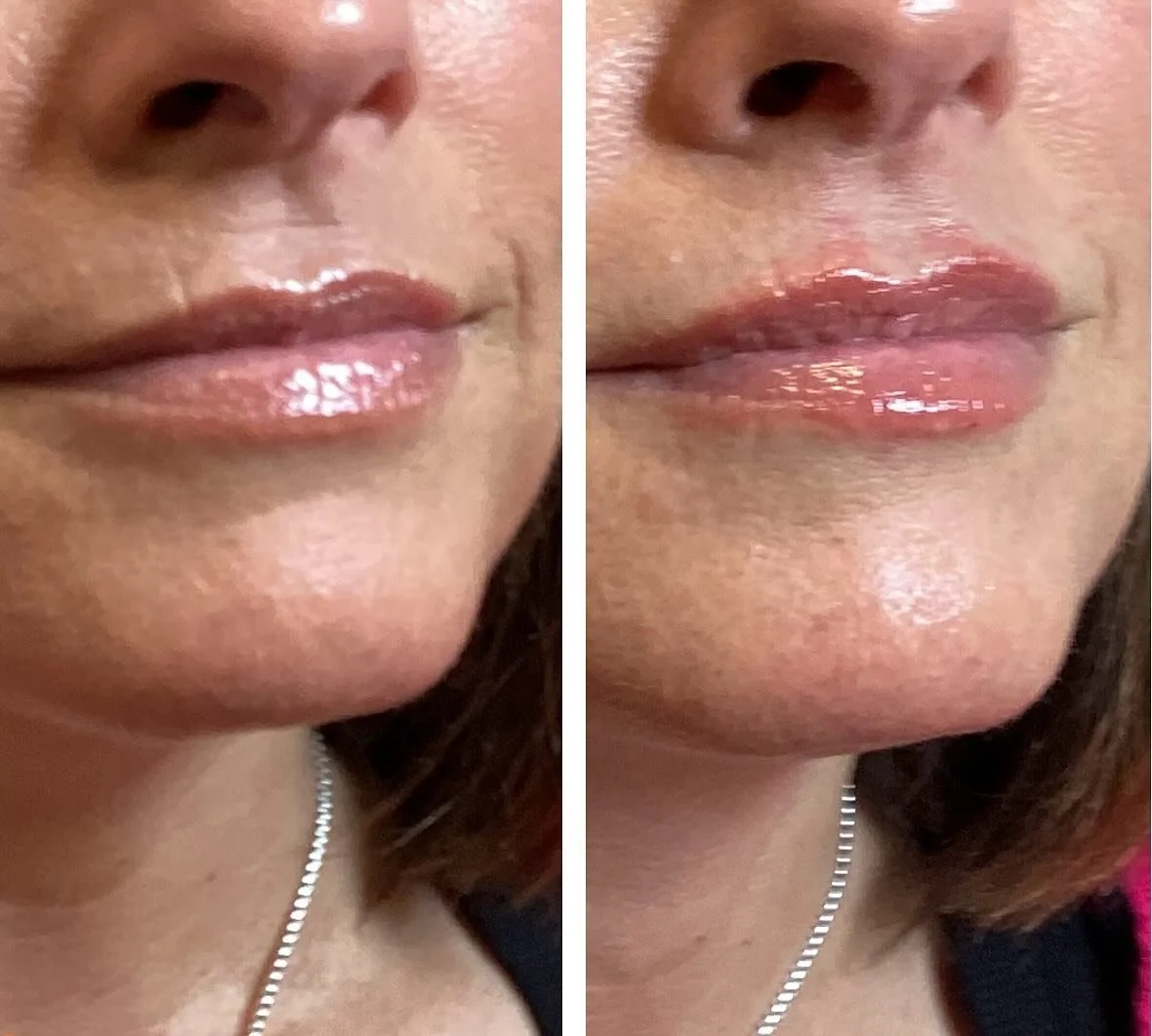 Mini lip filler 🙌🏼 just enough to make a difference but oh so natural🤍

Injector: Anna Castellanos, APRN-CNP