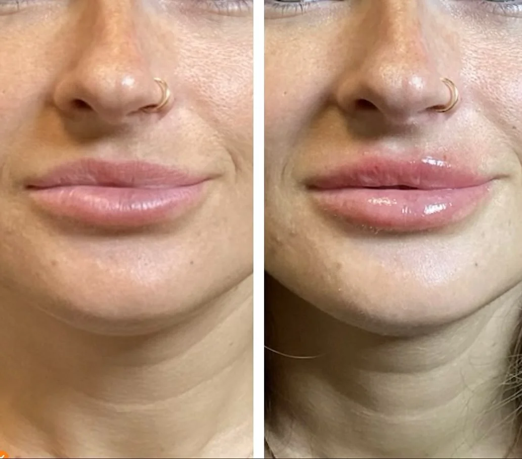 In LOVE! Mini lip filler session with a lip flip. PERFECTION. 
Injector-Anna Castellanos, APRN-CNP