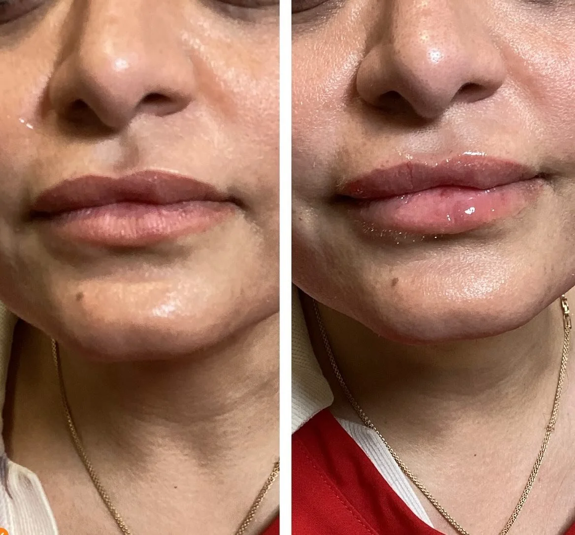 This queen looks 🔥 She is GLOWING! Mini lip filler session is just enough to give her more structure, hydration, and plump. 
Injector-Anna Castellanos, APRN-CNP