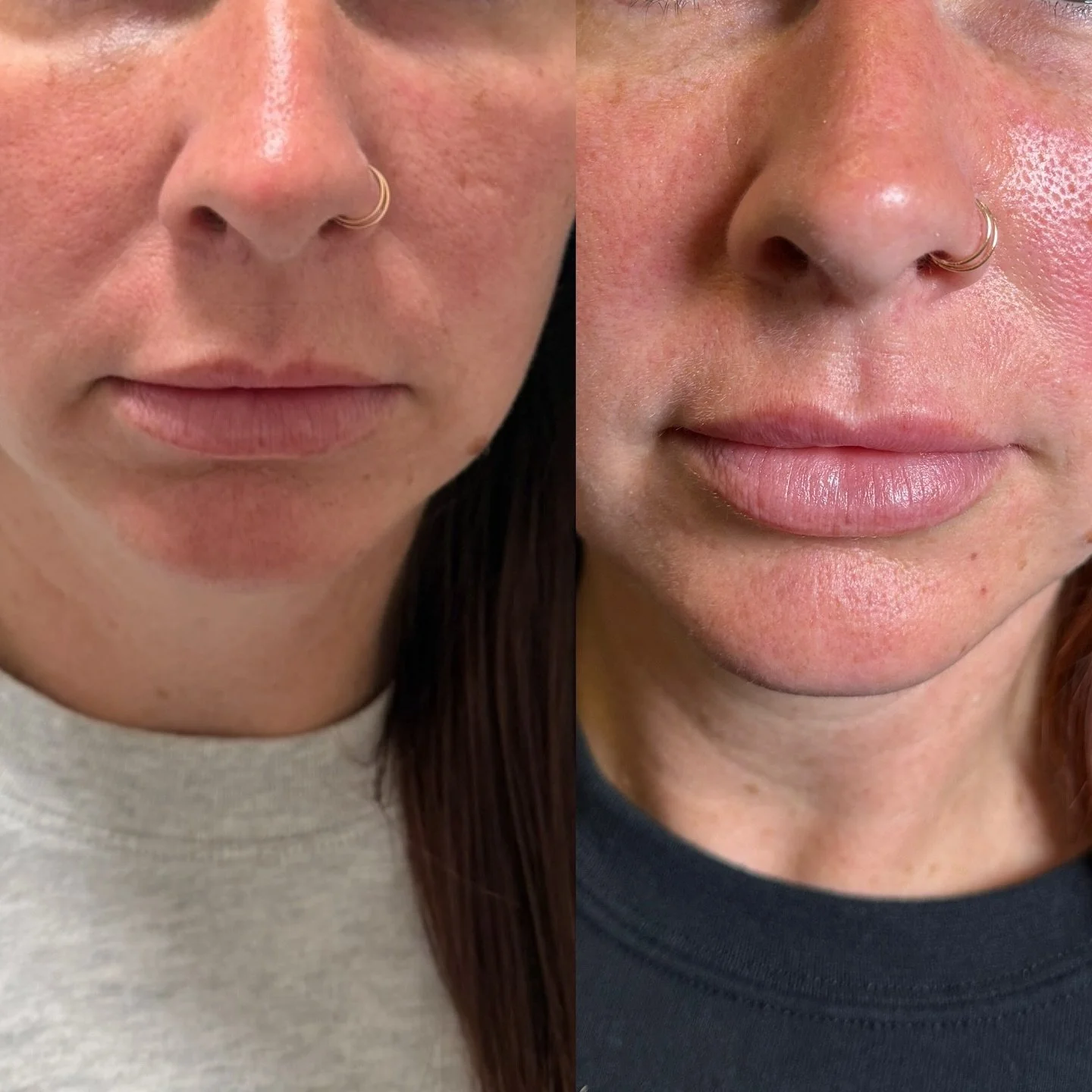 Less is always more 💋 Mini Lip Session 
RHA 3 
Focus: subtle volume and symmetry
Injector-Ashley Williamson, CNP 👩🏻&zwj;⚕️

#lipfiller #beforeandafter #lip