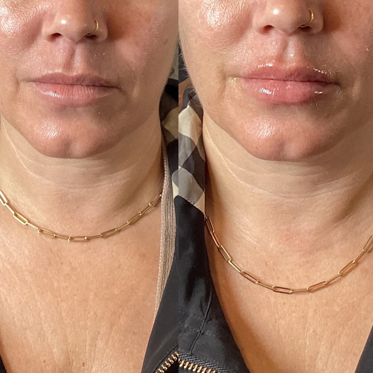 Holiday-ready lips ✨💋
Mini lip session = your perfect holiday lips! 
Injector-Ashley Williamson, CNP