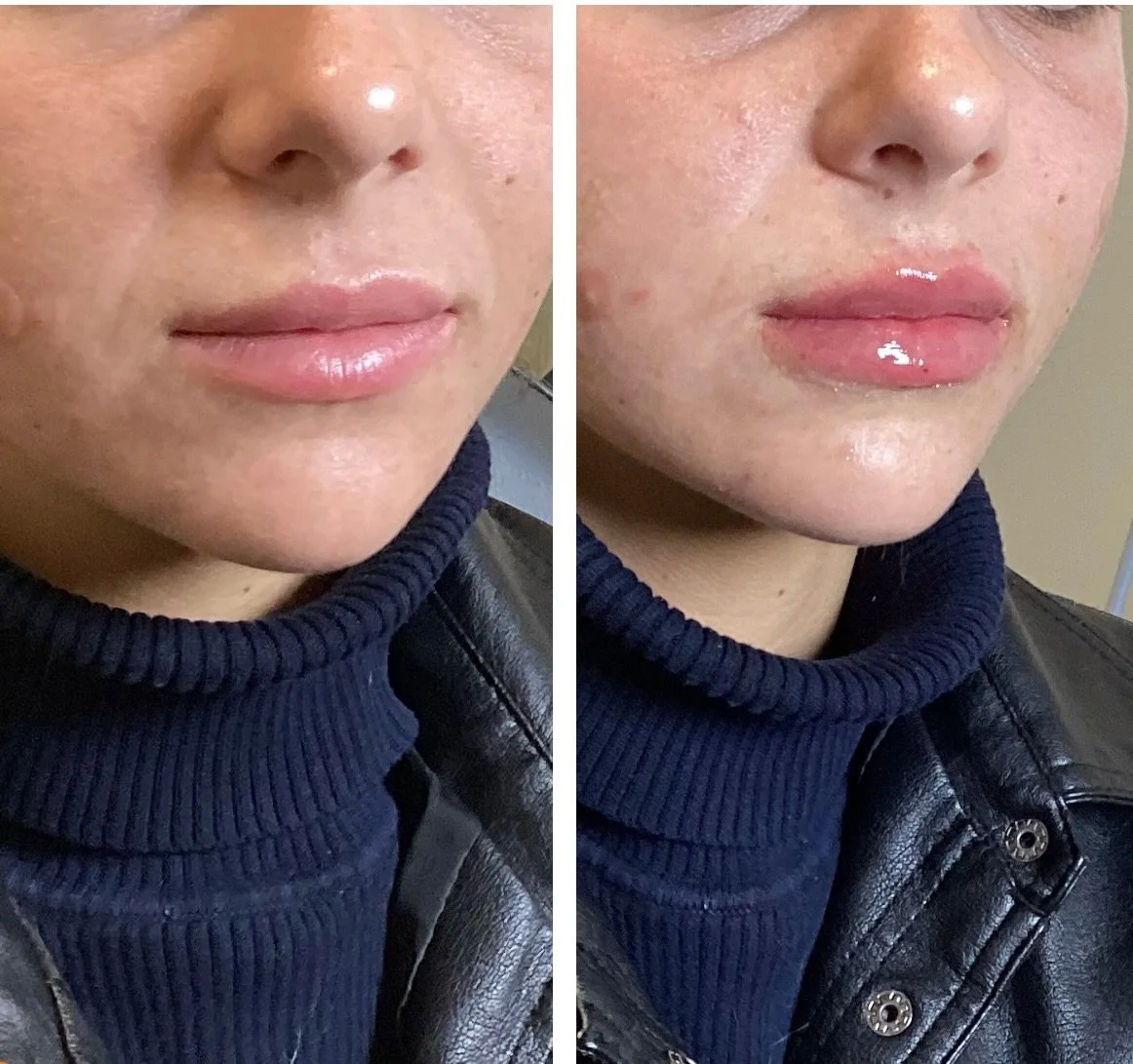 OBSESSED🫶🏼 This is 1/3 a syringe of filler with a flip🤯 Book your holiday lips asap.
Injector: Anna Castellanos , APRN-CNP