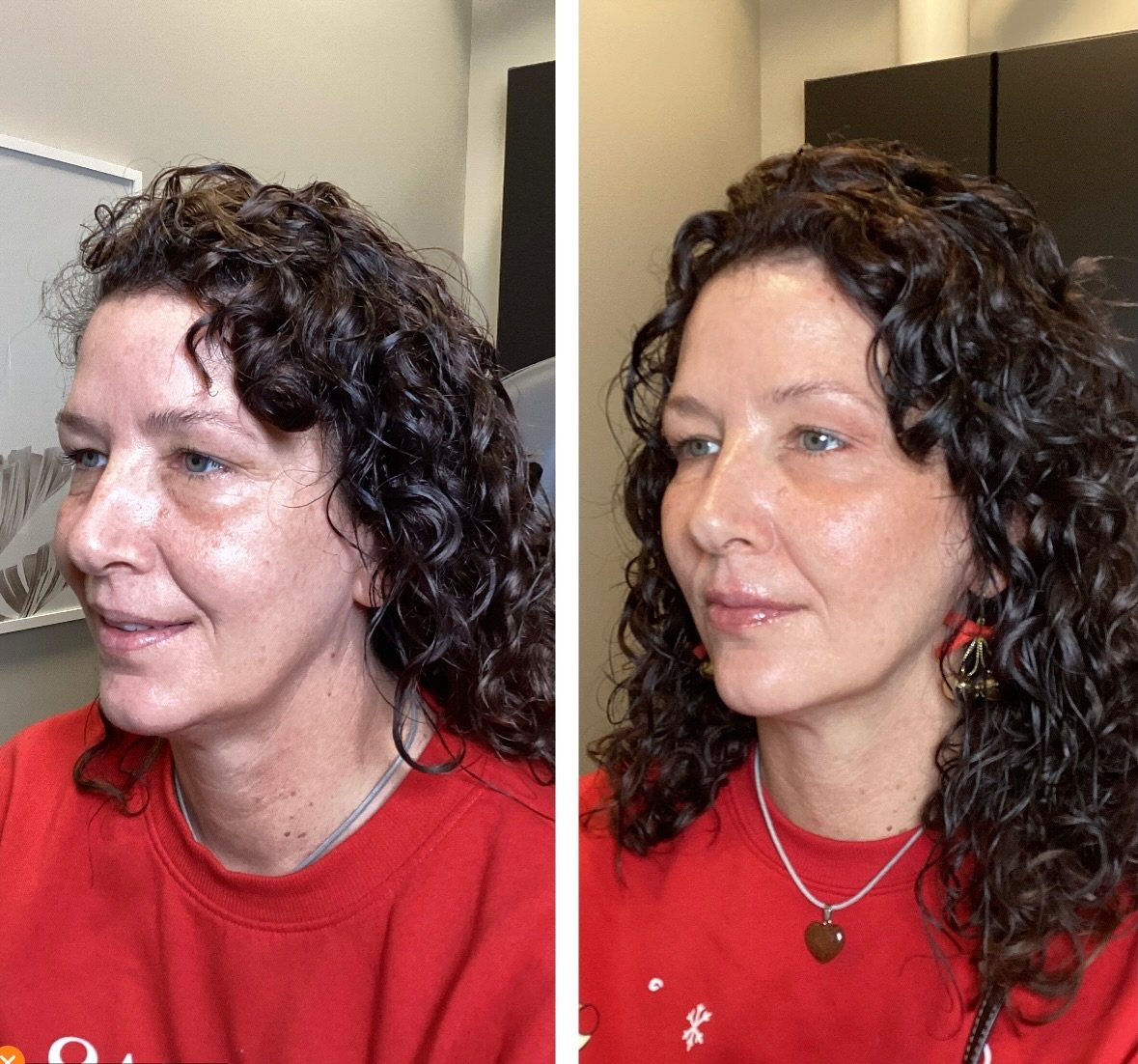 In LOVE with these results! RHA 3 and Evolus FORM filler used to treat, cheeks, tear troughs, nasolabial folds, and lips. Look at the improvement in balance and skin quality! Book with myself or Ashley today!

Injector-Anna Castellanos, APRN-CNP

#fi