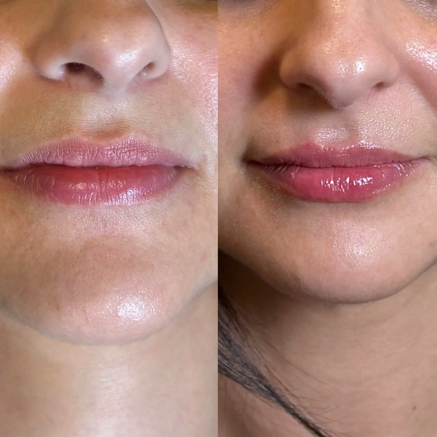 Mini lip session 💋 
-Injector Ashley Williamson, CNP 

#lips #filler