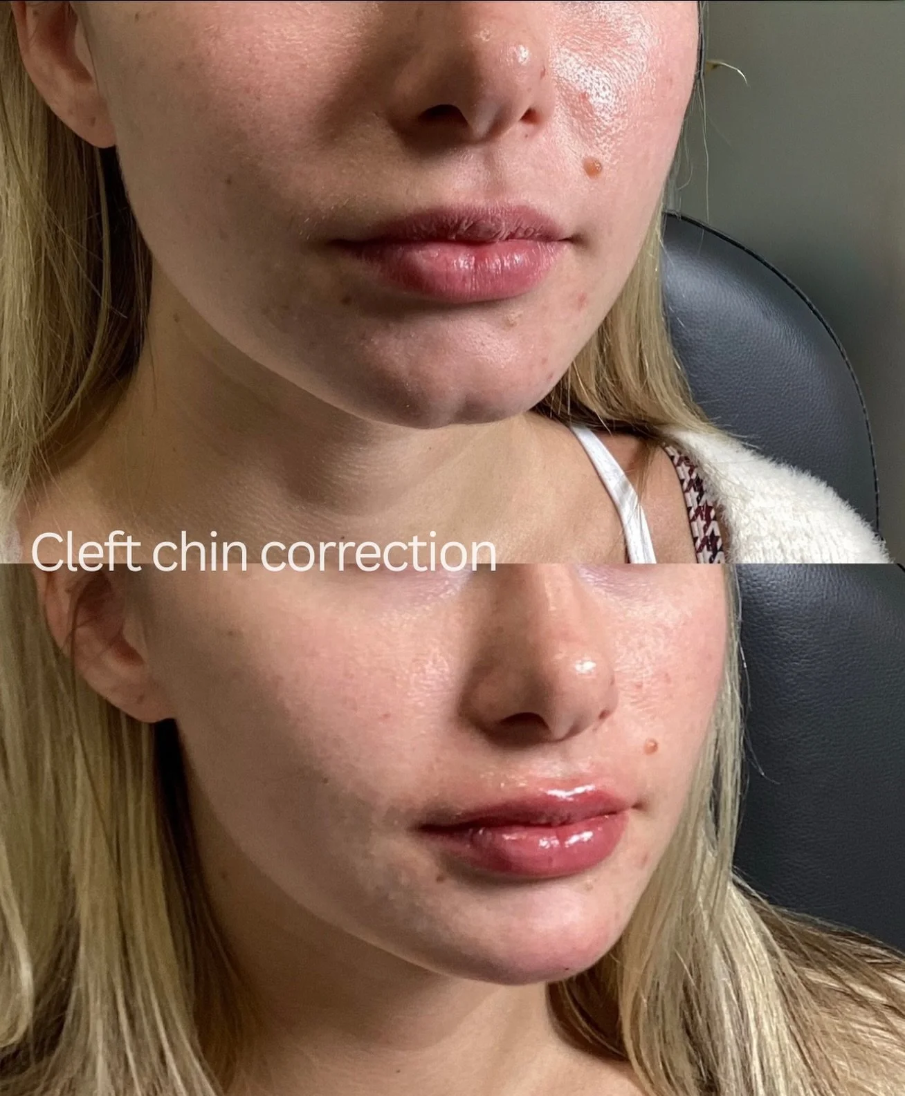 Let&rsquo;s talk about balance.

This patient initially came in concerned about her chin.
After assessment, it was clear the goal wasn&rsquo;t to &ldquo;add volume&rdquo; &mdash; it was to improve proportion.

A cleft chin can sometimes create a smal