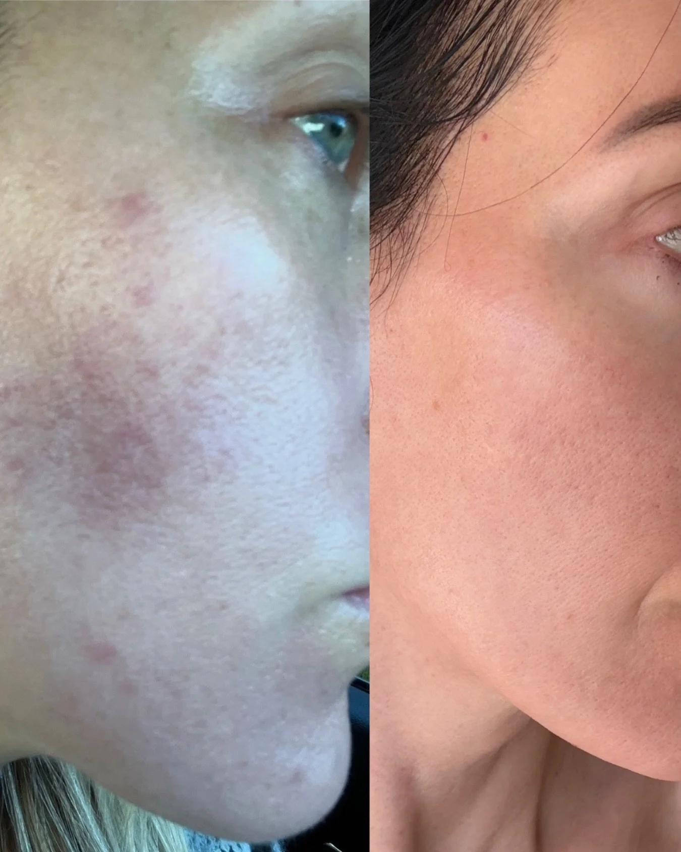 1 year apart.

This result wasn&rsquo;t created with more products.
It was created with strategy.

Barrier healing.
Inflammation control.
The right products.
The right treatments.
Consistency.

Healthy skin isn&rsquo;t built by chance.
It&rsquo;s bui