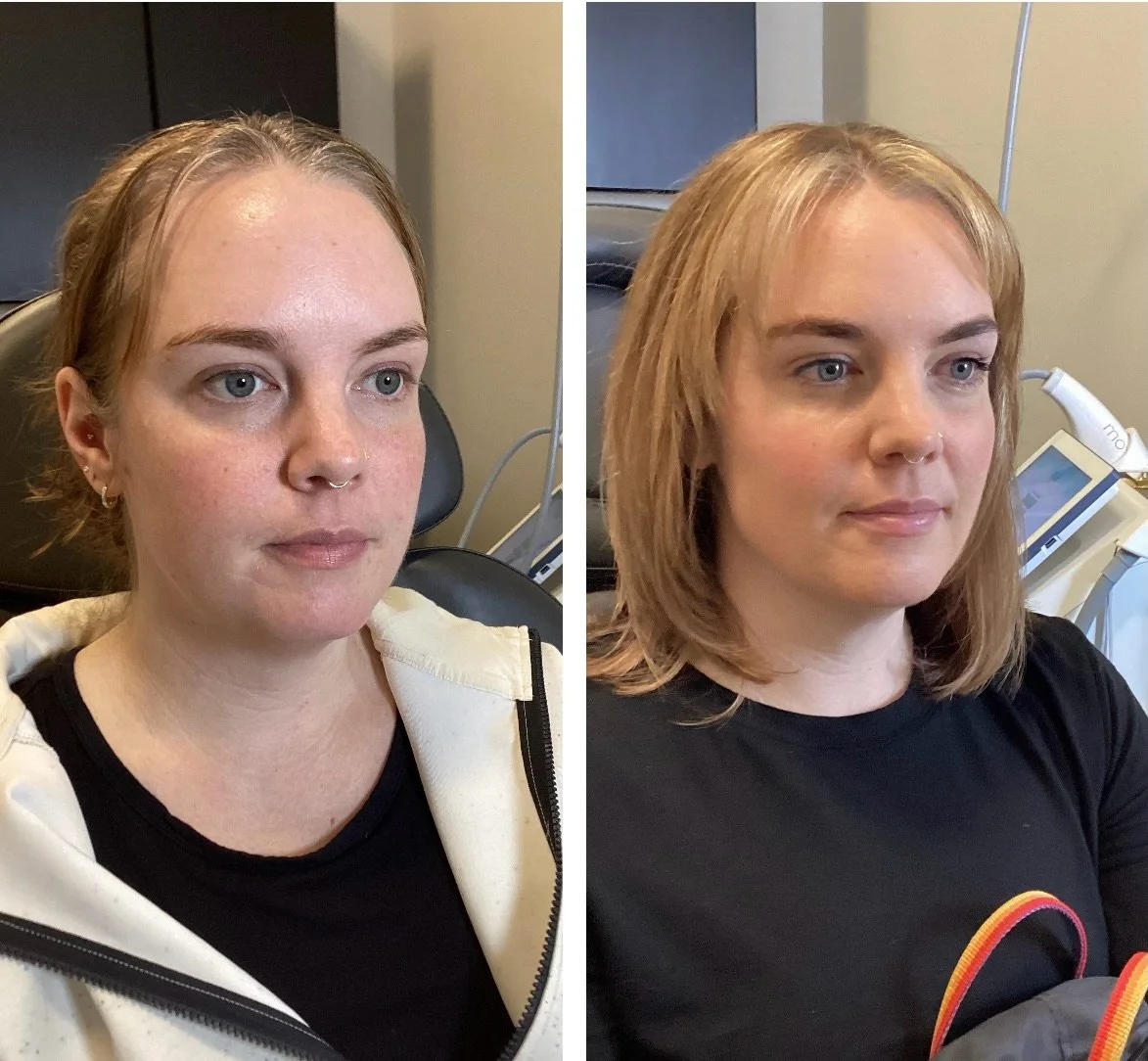 This result still has me swooning over here! This beautiful patient came to me for a consultation with goals of snatching her jaw. I ended up placing filler in the jaw, chin and cheeks for a WOW effect. We are both so happy with her results. Schedule