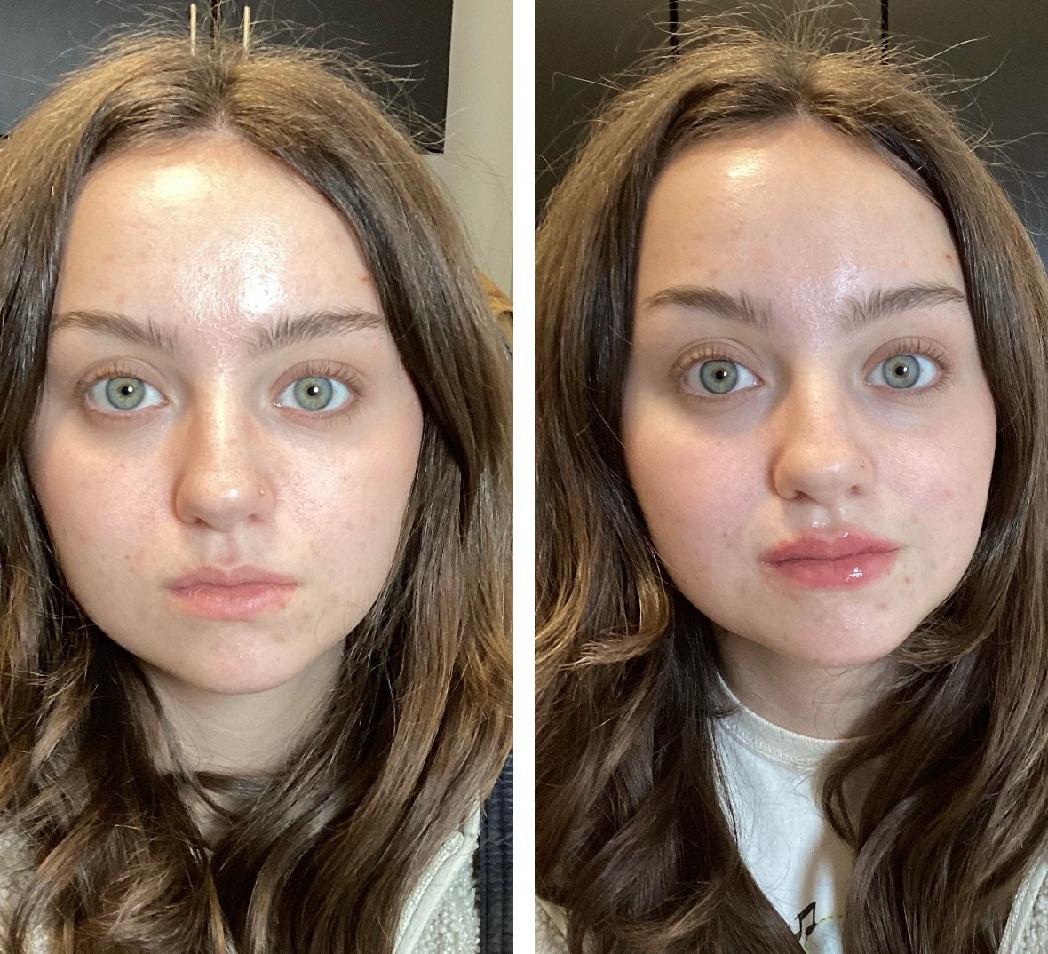 More lips!!! Pouty, plump, and perfect lip filler.

Book your today💋
Injector: Anna Castellanos, APRN-CNP