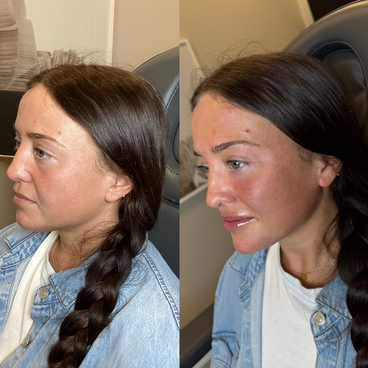 Facial balancing is not about adding volume everywhere. It starts with assessing the face as a whole and understanding how each feature contributes to overall harmony and proportion.

When this patient came in, she felt her face appeared round and la