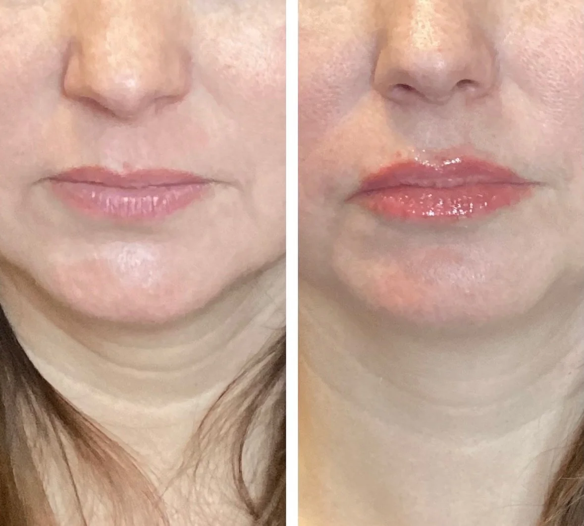 So pretty!! Natural, balanced lips for my first time filler client. Come get your lip glow up with Ashley or myself! 💋

Injector: Anna Castellanos, APRN-CNP