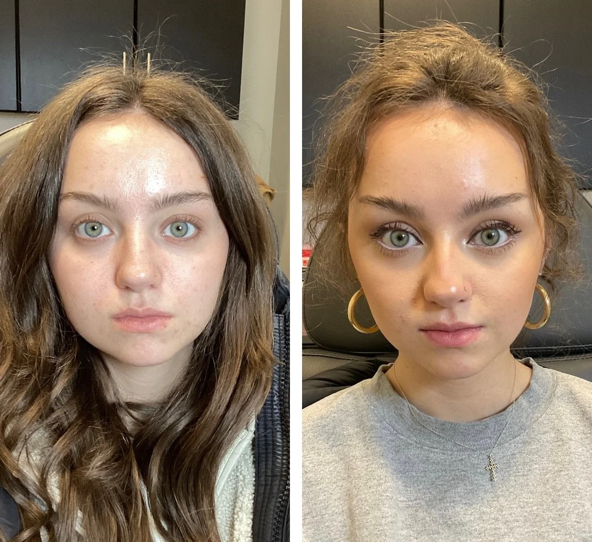 Before: Filler virgin
After: 2 week follow up, healed lips. 
99% of the time we show you pictures of lips right after they have been injected with filler. As you can see, she looks completely natural/subtle. Many of her asymmetries and volume gaps ha