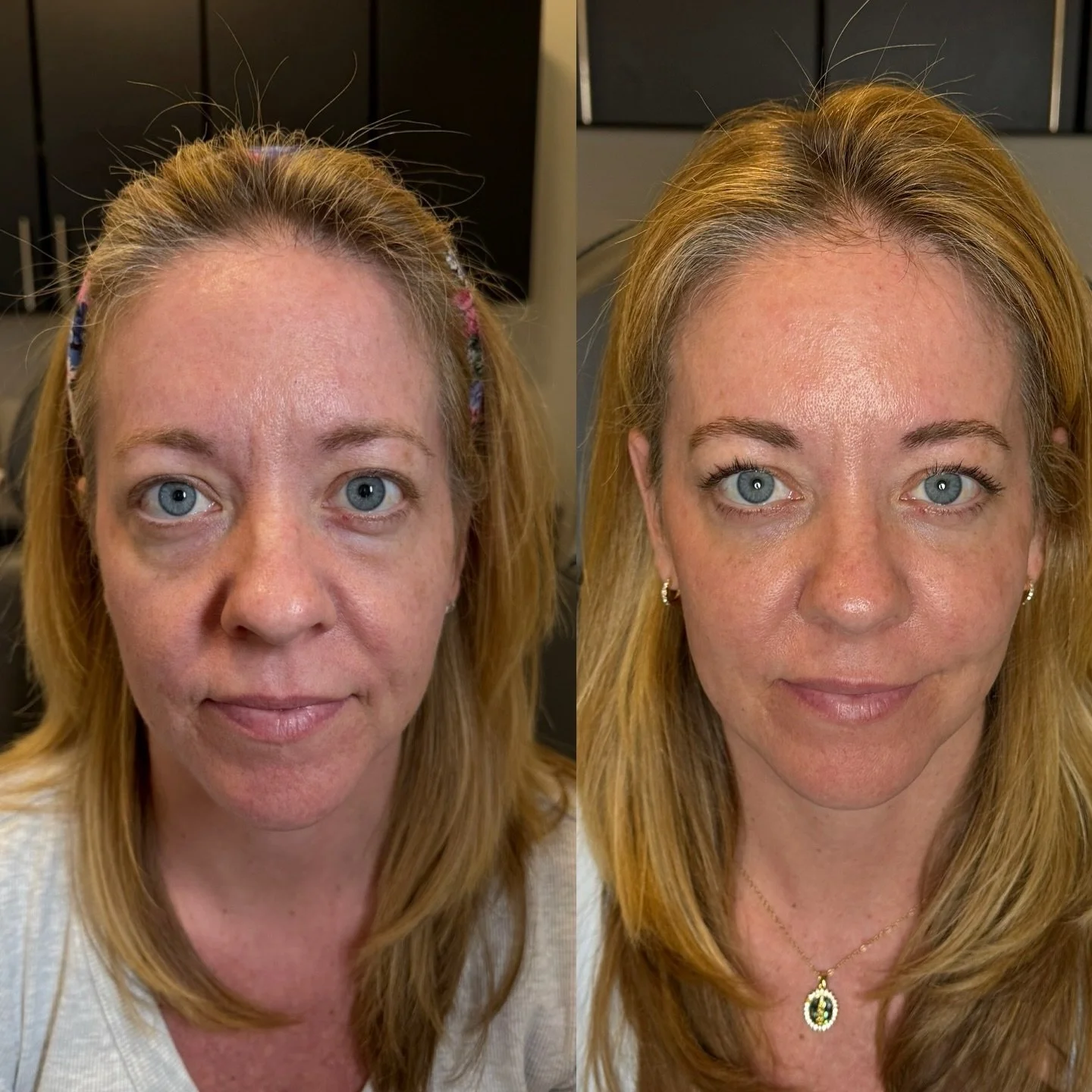 Most people think their under-eyes are the problem.

When she came in concerned about her tear troughs, we performed a full facial assessment and created a treatment plan focused on restoring balance to the face.

Treatment included tear trough corre