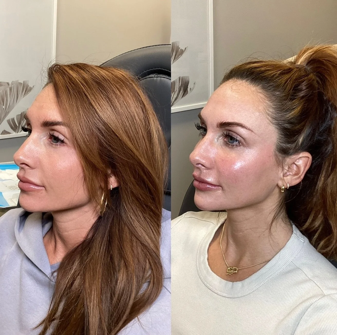 The goal was never to change her face.
The goal was to give her back the confidence she already had.
- Injector Ashley Williamson, APRN-CNP. 📍 The Confidence Lab &mdash; Powell, Ohio
📞 614-219-9983
🔗 www.myconfidencelab.com.  #powellohio #beforean