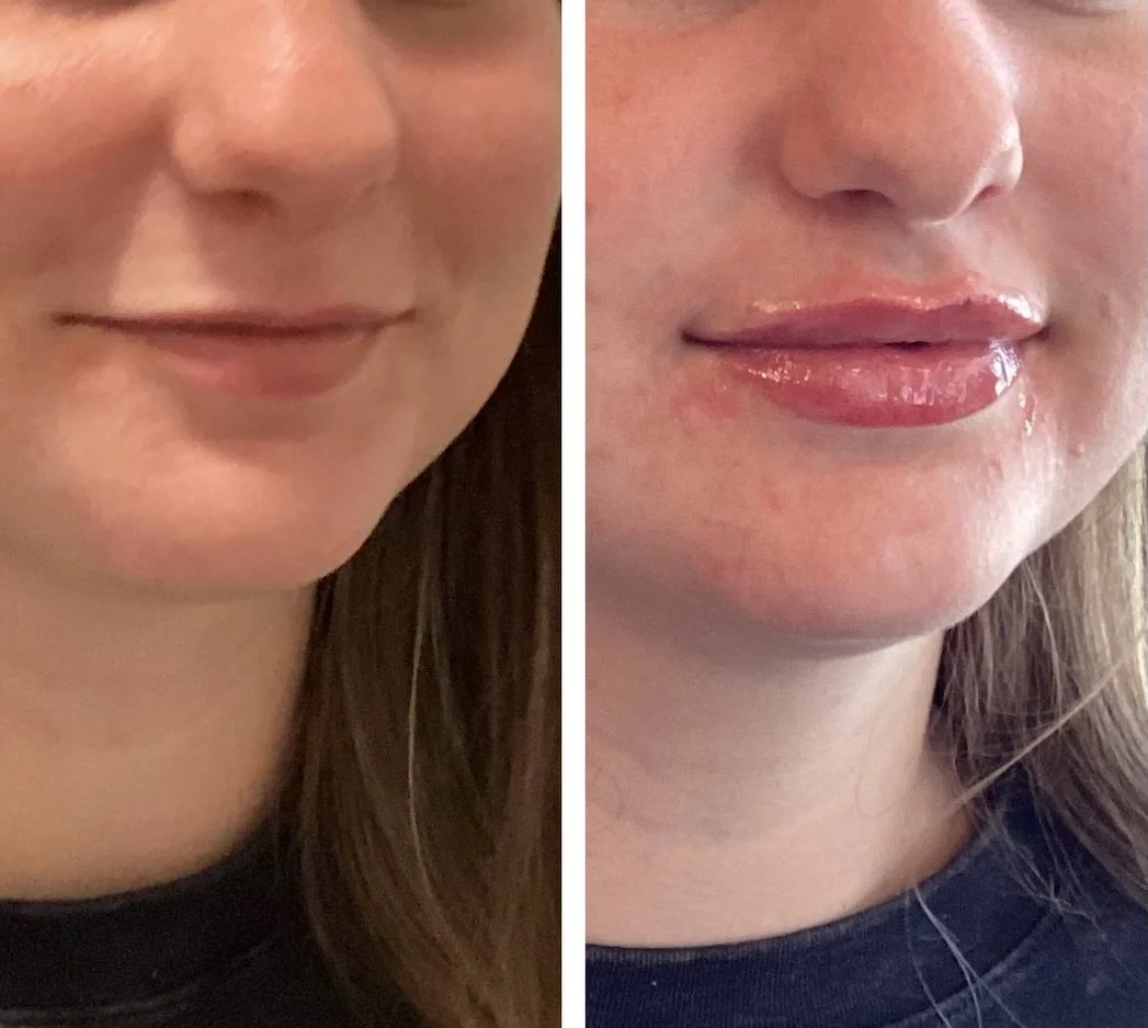 I love a good lip transformation! Lip filler can help with height, volume, symmetry, and projection. The most common concerns I hear:  I don&rsquo;t want to look fake➡️I&rsquo;ll never let that happen!

I don&rsquo;t want to look like a duck➡️Properl