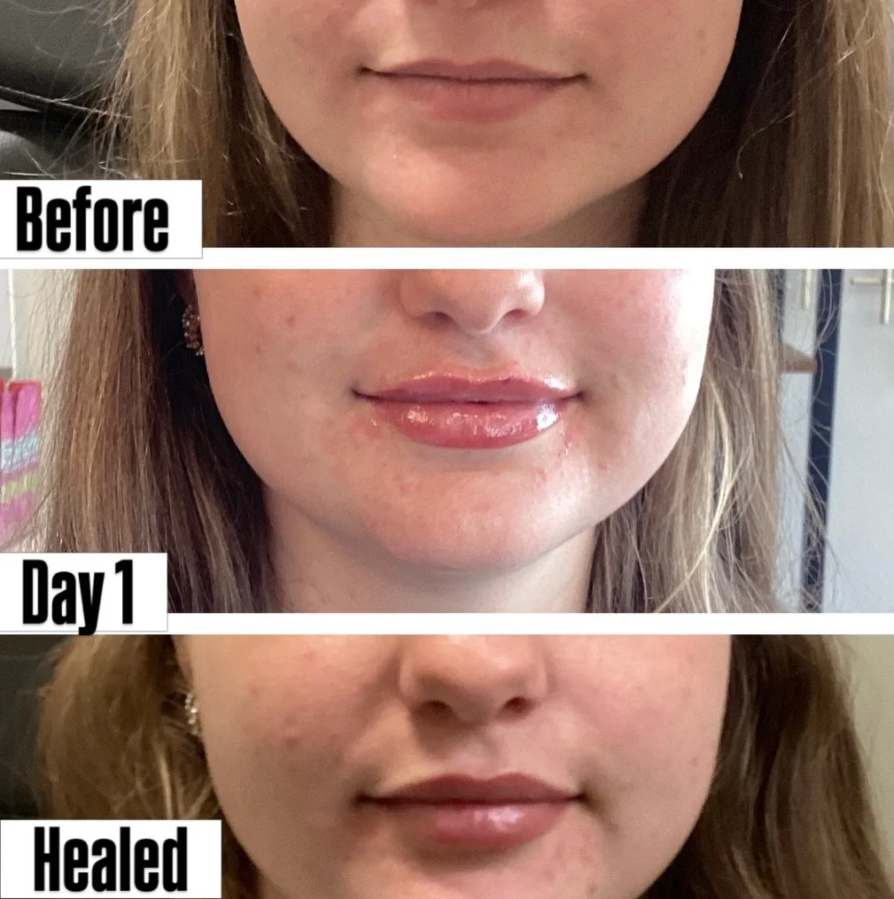 Two week follow up lip filler results. Nailed it! 👄💉
Injector: Anna Castellanos, APRN-CNP