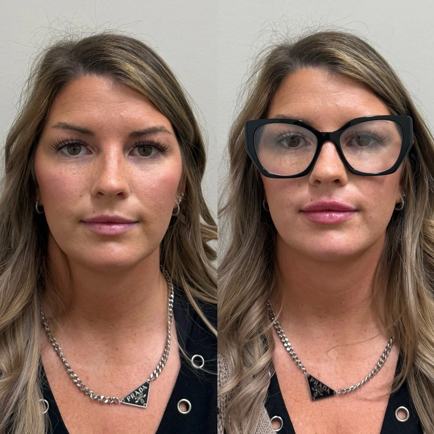 This result happened over two sessions.

Session one &mdash; balance and reshape. We assessed her face as a whole before adding anything.

Session two &mdash; subtle volume. Only after the foundation was right did we give her what she came in for.

R