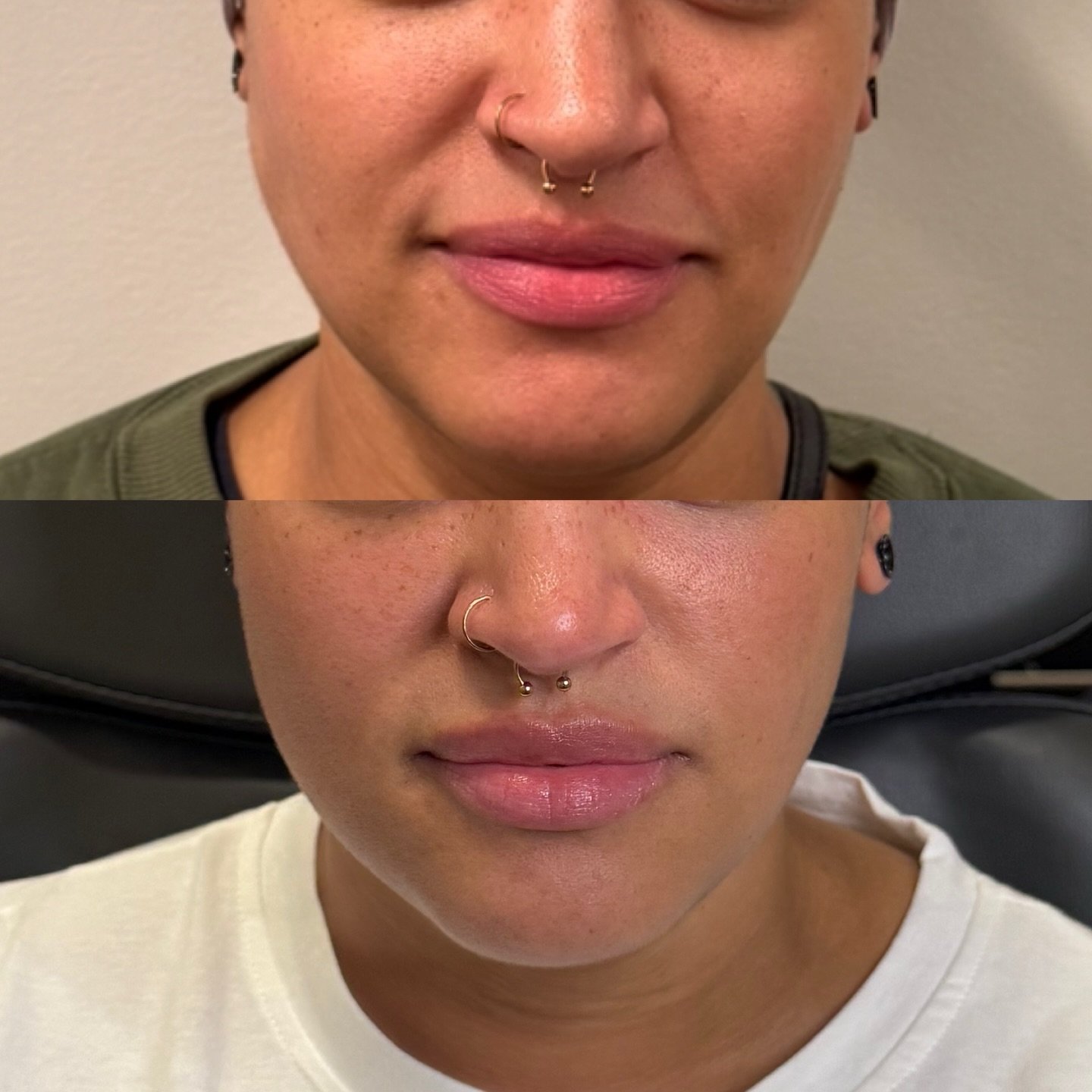 Her lips already had volume &mdash; so why didn&rsquo;t they feel balanced?

She came in with naturally full lips, but lacked definition through the Cupid&rsquo;s bow and vermilion border. The volume itself wasn&rsquo;t the issue &mdash; it just lack