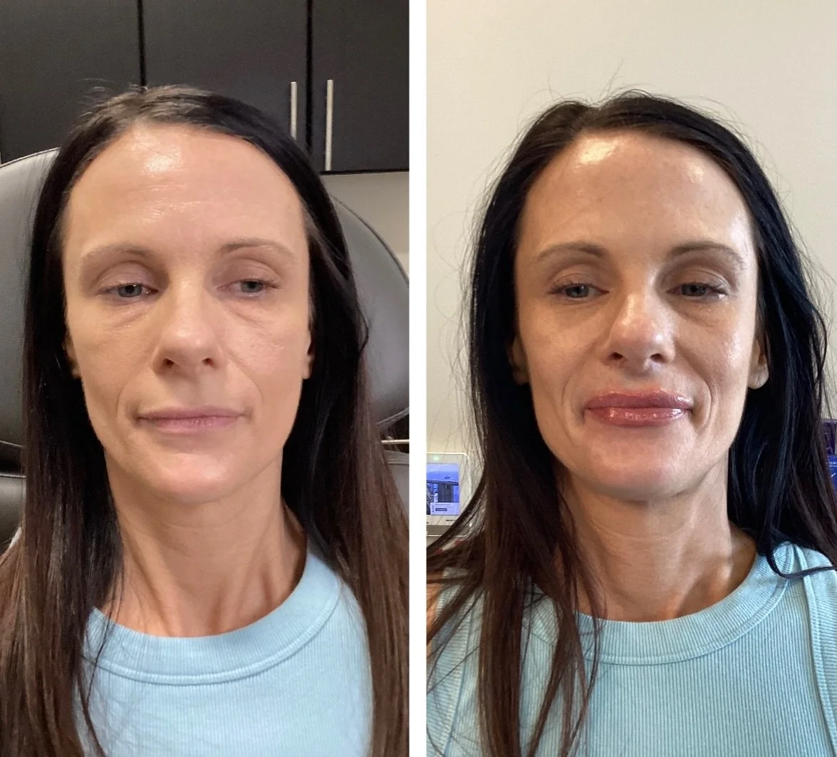 My client looks balanced and beautiful!! She came in for a lip flip but after explaining  that a lip flip will not give her any volume we decided the best route was filler. End result, 1000% natural looking but brought balance to her proportions. Boo