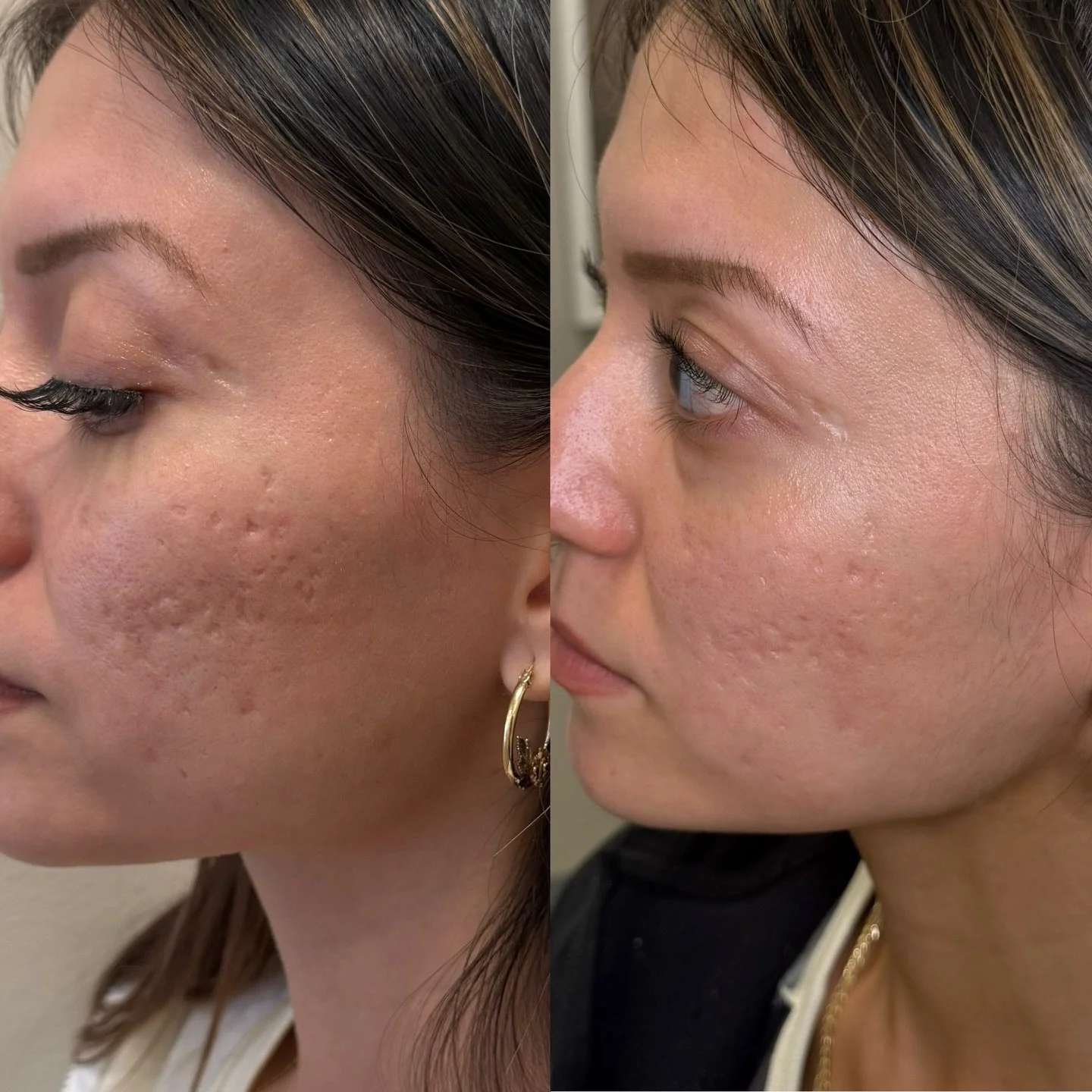 4 weeks apart, and we&rsquo;re just getting started! Acne scars are not a one-treatment fix.

Deeper scars are often tethered beneath the skin by fibrotic bands and damaged collagen &mdash; which is why true acne scar correction takes multiple modali