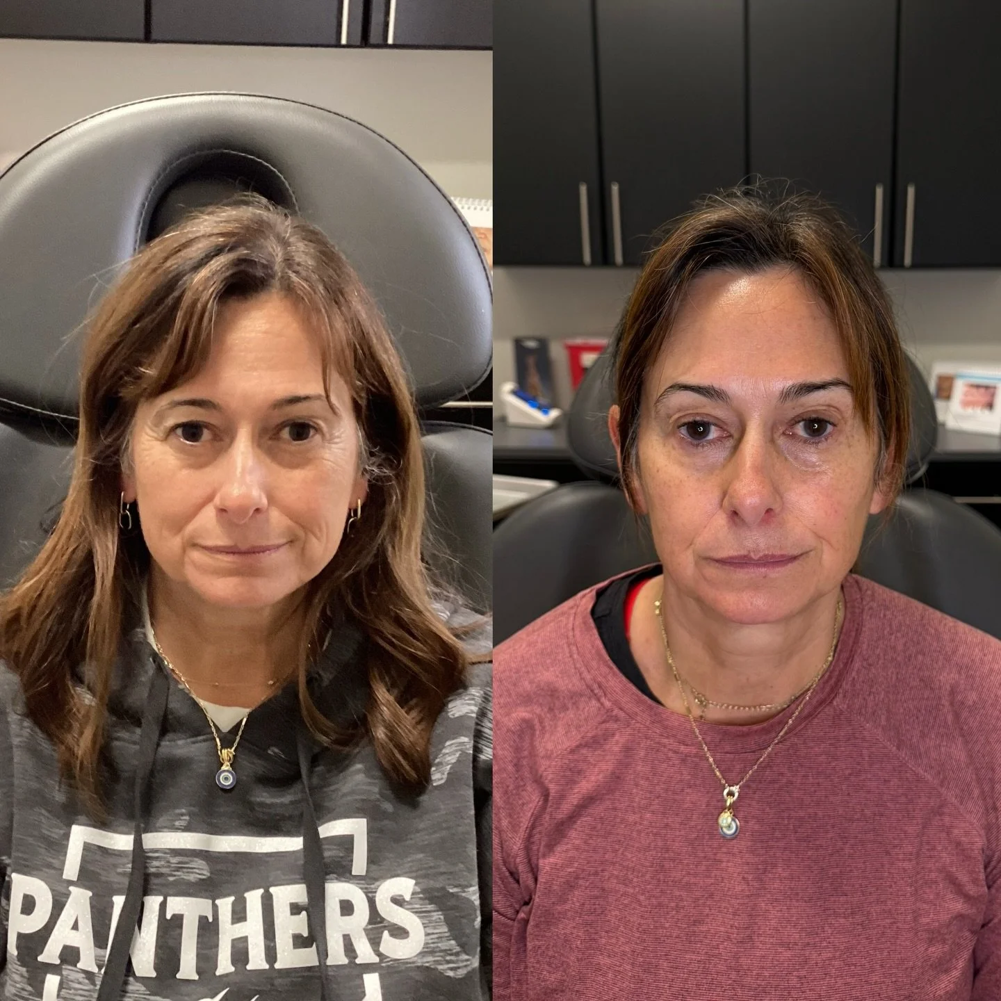 ✨This beautiful result was achieved with Jeuveau and skincare alone.

One of my favorite details? The subtle eyebrow lift. 👌

If you look at the before photo, you&rsquo;ll notice mild hooding of the upper eyelids. Through strategic neuromodulator pl