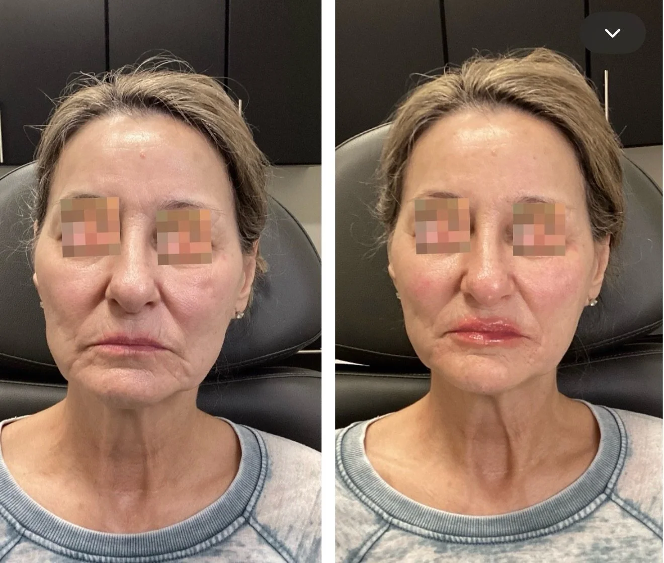 Just a little bit of filler went a LONG way. Look at those cheeks and marionette lines (the vertical wrinkles or creases that extend from the corners of the mouth downward towards the chin)! What a beautiful result for an amazing new client. Book you