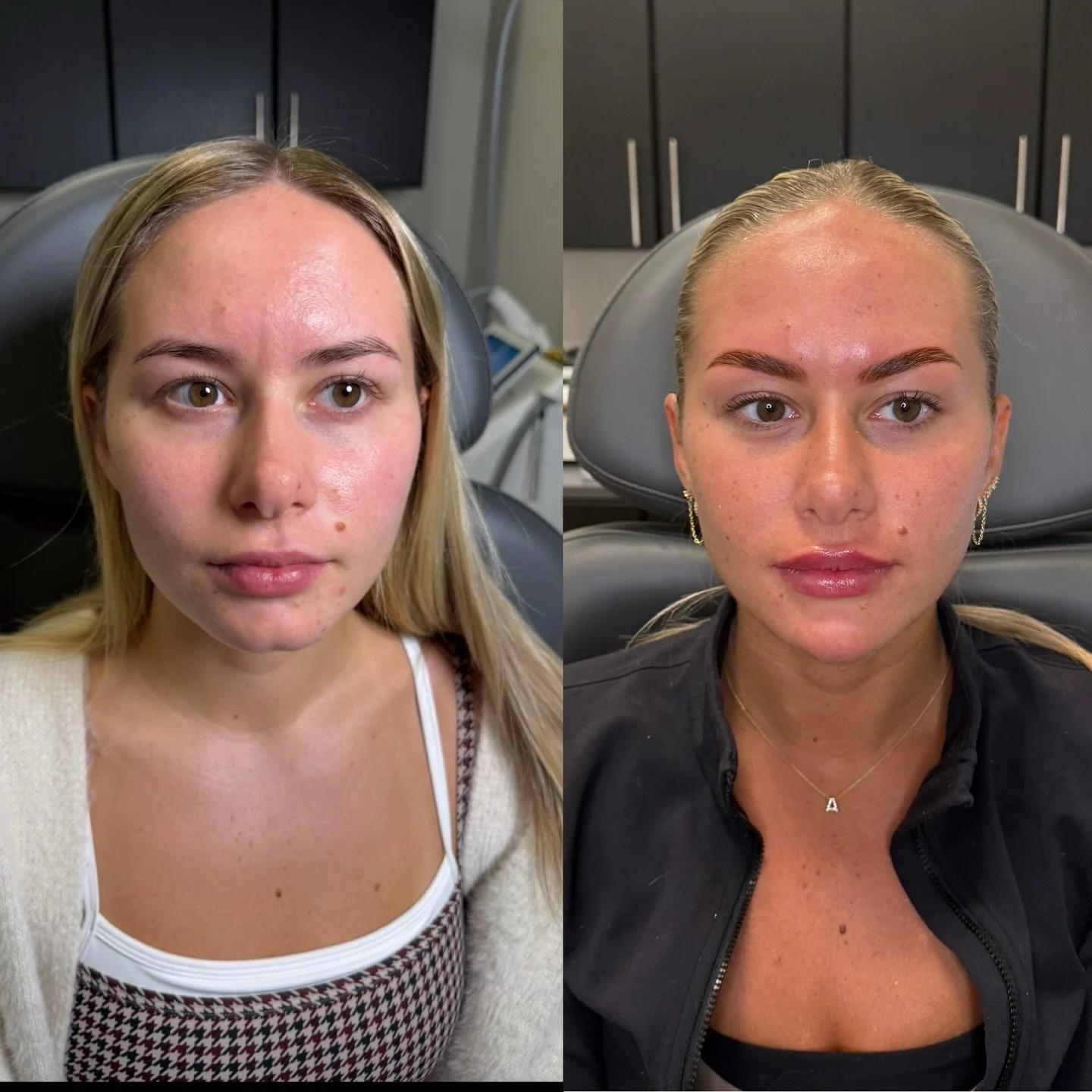 Loyal clients don&rsquo;t just come back. They fly back. ✈️🤍

Honestly, that&rsquo;s one of the greatest compliments to receive.

About a year ago, we corrected her cleft chin and created balance through facial harmonization. Today was all about mai
