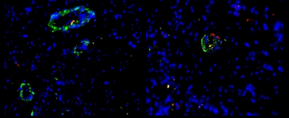 Vascular Organoid Patches Offer New Hope for&nbsp;Coronary Artery Disease&nbsp;Treatment &nbsp;