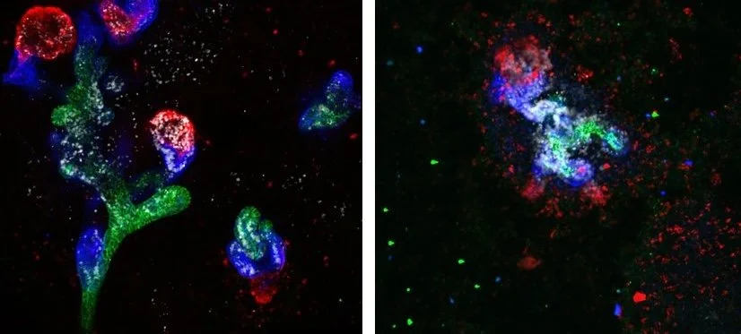 Stem Cell Model of Diabetic Kidney Disease Identifies Inflammation as Therapeutic Target