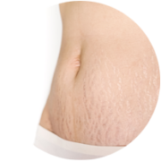stretch-marks-180x180.png