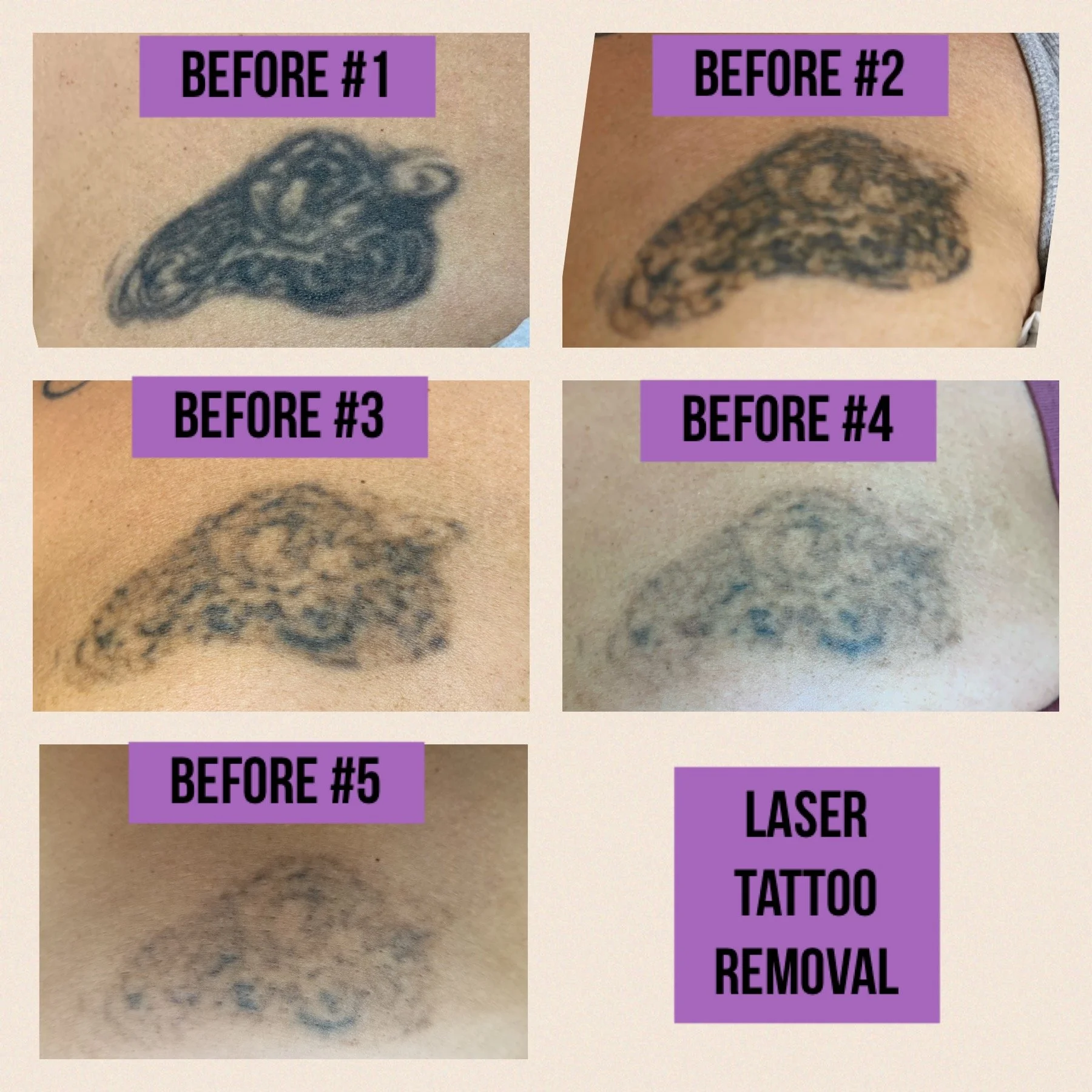 Tattoo Removal — The Laser Clinic