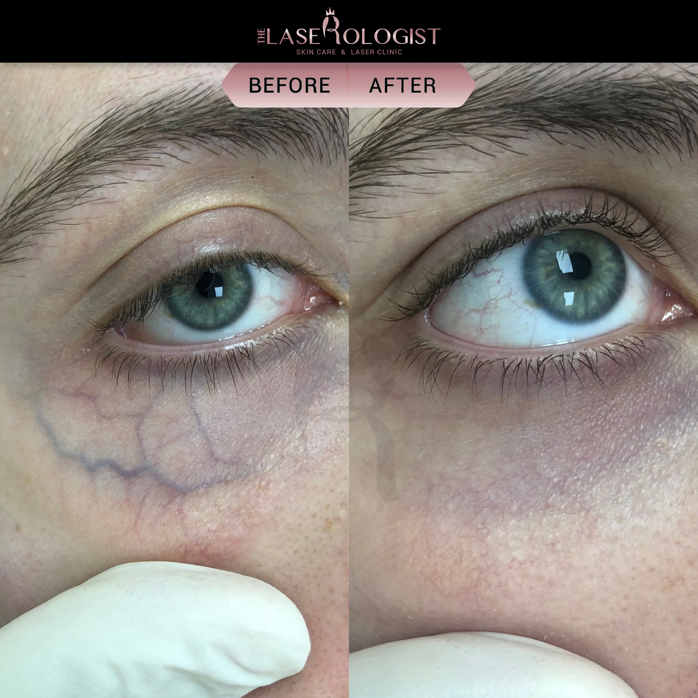 Periorbital Veins — The Laserologist