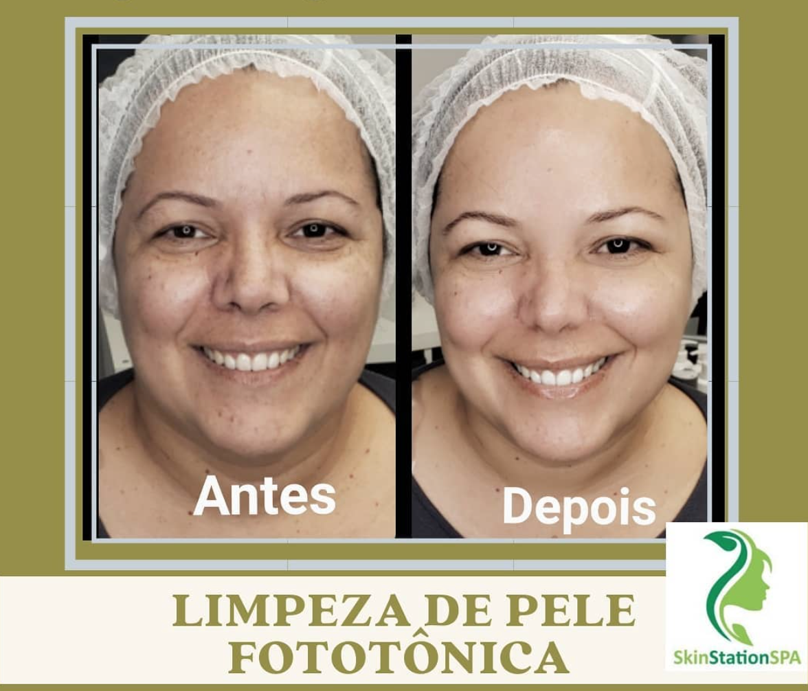 Signature Facial Cleansing + Photonic Treatment