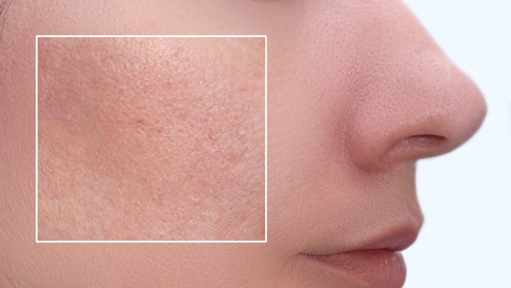 Enlarged Pores Treatment — Skin Station Spa Deerfield Beach Florida
