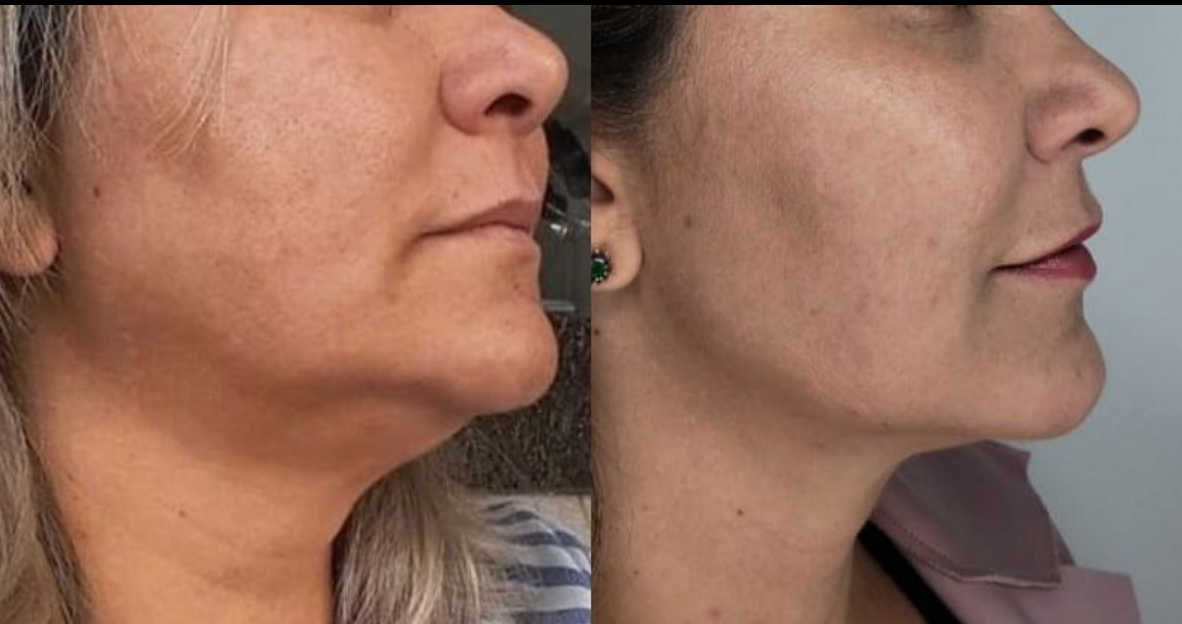 Microneedling
