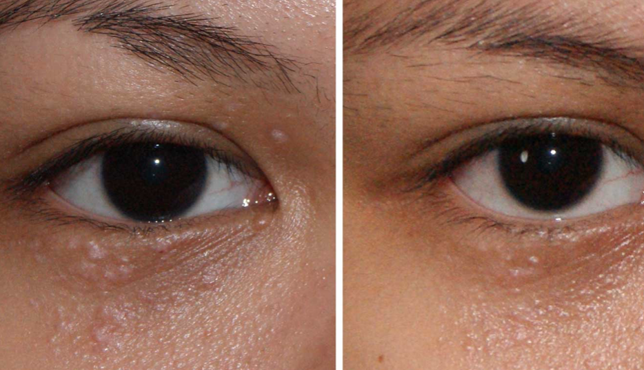 Syringoma Treatment