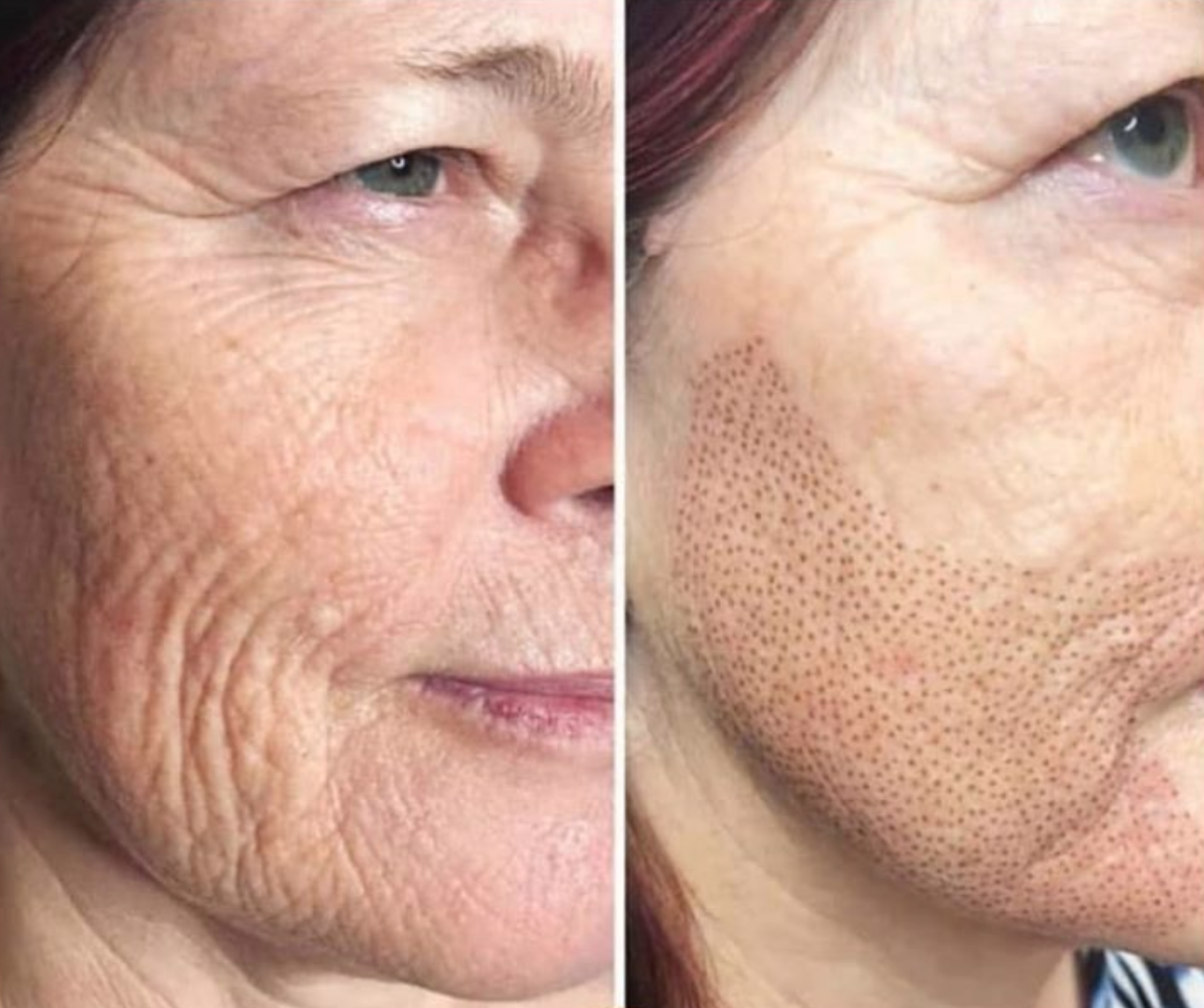 Microneedling