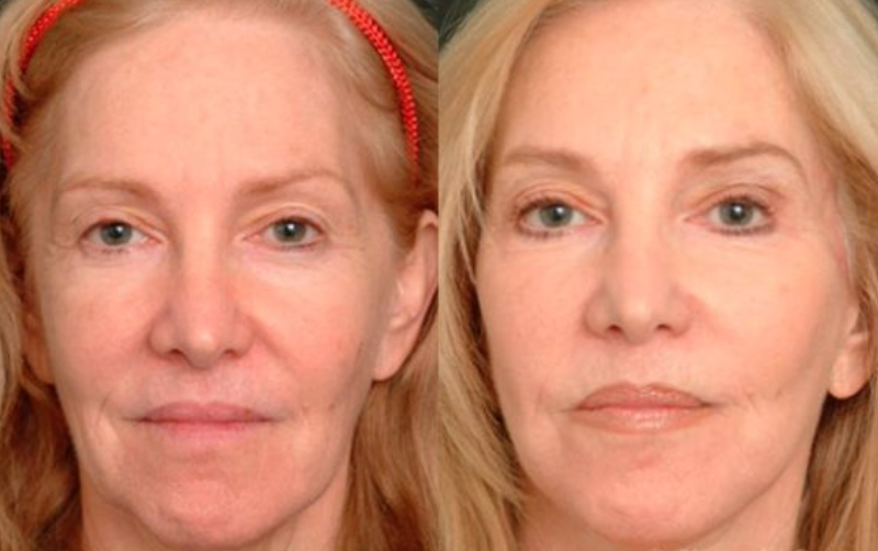Microneedling