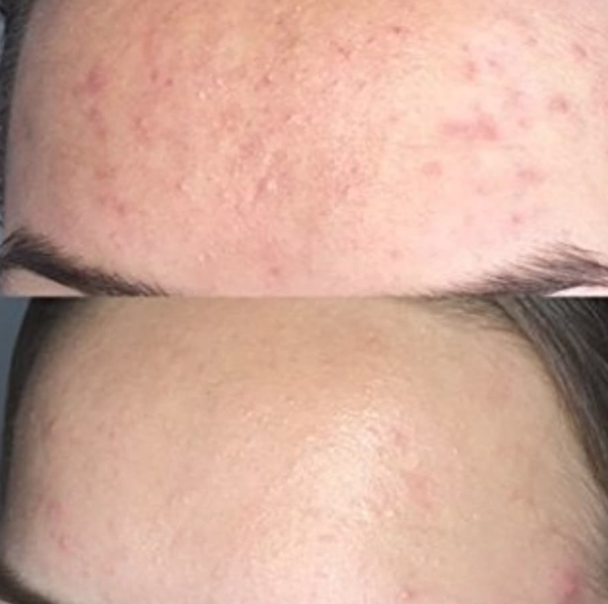 Acne Treatment