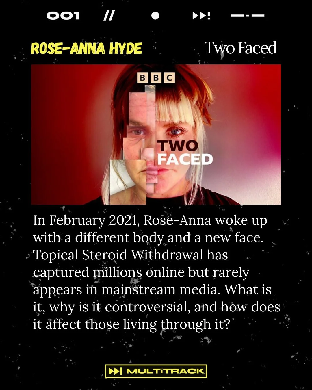 ✨ Fresh Fellow Commissions ✨
Two Faced Produced &amp; Sound Designed by Rose-Anna Hyde

After waking up with a different face in 2021, Rose-Anna began navigating Topical Steroid Withdrawal. A powerful, personal exploration of a condition rarely heard