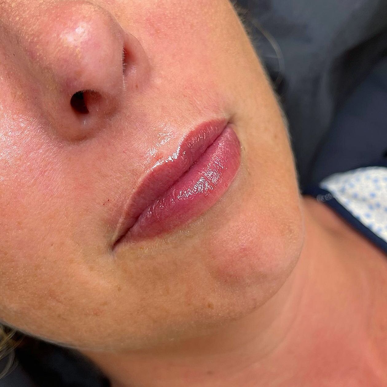 Hyaluron Pen Lip Injection👄💉💉
&mdash;&mdash;&mdash;&mdash;&mdash;&mdash;&mdash;&mdash;&mdash;&mdash;&mdash;&mdash;&mdash;&mdash;&mdash;&mdash;&mdash;&mdash;&mdash;&mdash;&mdash;&mdash;&mdash;&mdash;&mdash;&mdash;&mdash;
Lasts: 3-6 month
Needle Fre