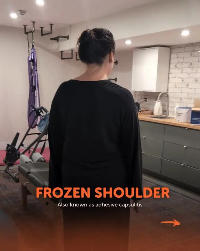 Frozen shoulder, also known as adhesive capsulitis, often shows up as stiffness, reduced shoulder movement, and difficulty with everyday tasks like reaching, dressing, or sleeping.

Chiropractic care can be part of a supportive approach by focusing o
